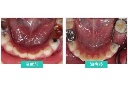 兒童牙科 - 乳牙後牙治療