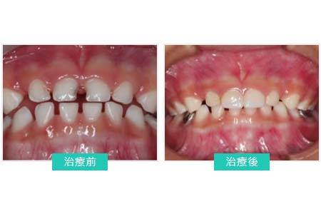 兒童牙科 - 乳牙前牙治療