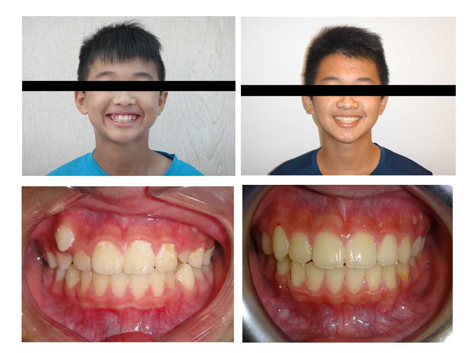 隱適美不拔牙矯正