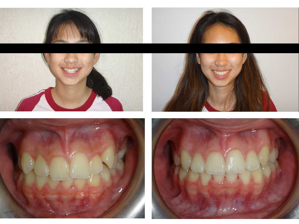 自鎖式矯正器不拔牙矯正