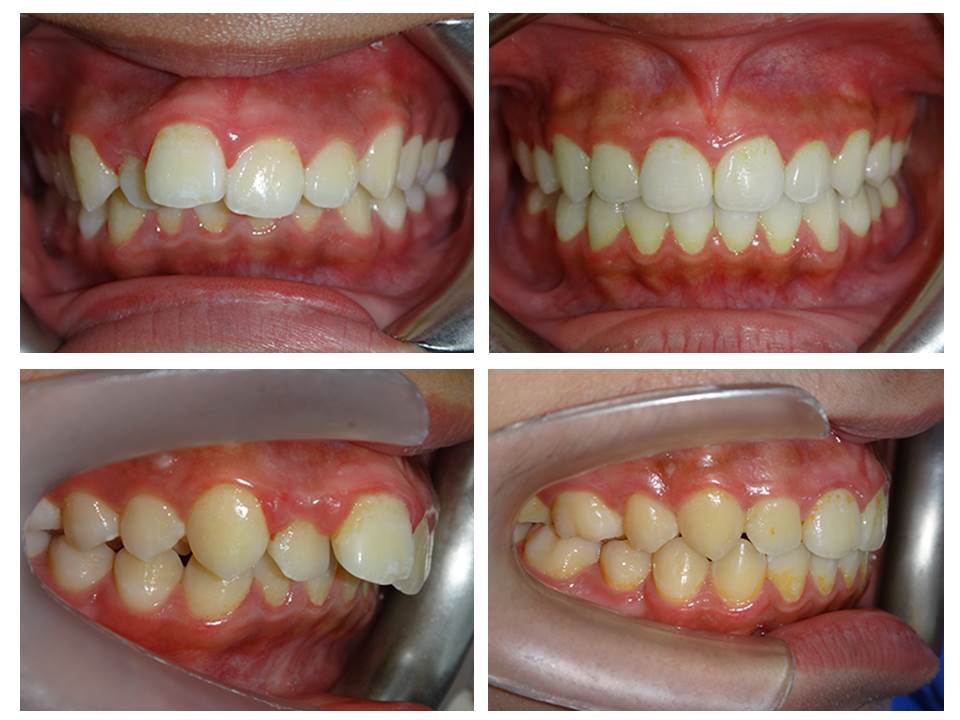 隱適美拔牙矯正
