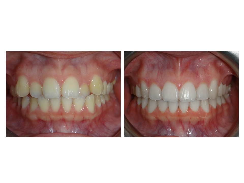 自鎖式矯正器不拔牙矯正