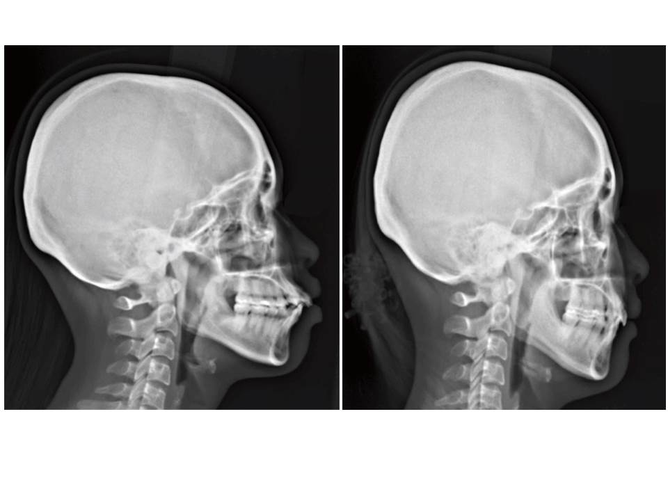 隱適美拔牙改臉型 (一)