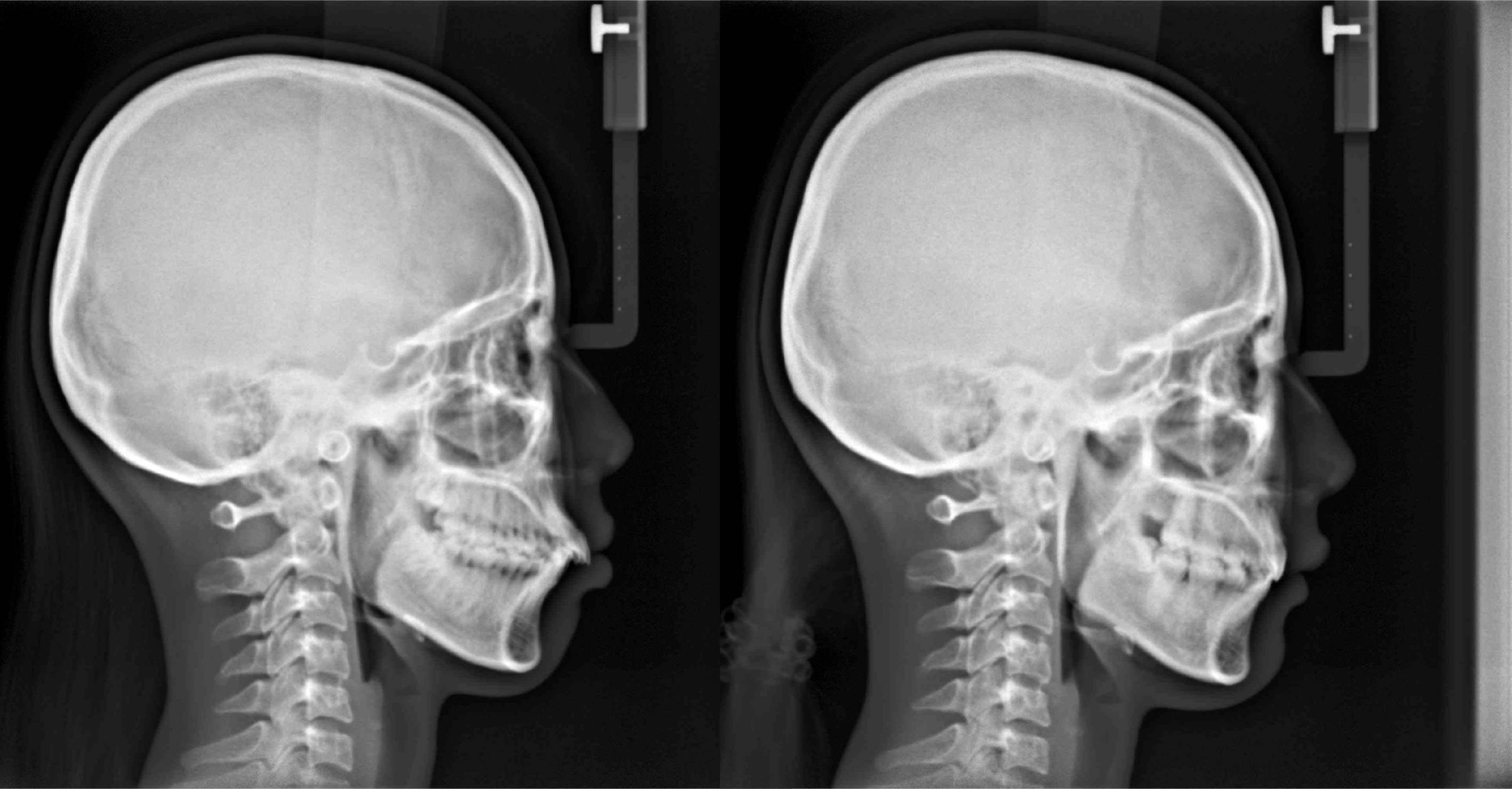 隱適美拔牙改臉型(二)
